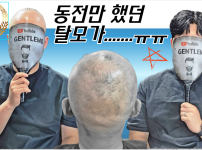동전만 했던 탈모..31살에 전체가발을 쓰게…