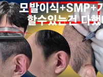 두피문신+모발이식+가발 3종세트 결과는?